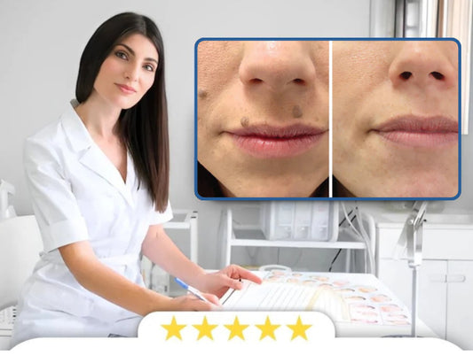 Renhud - Salva för borttagning av vårtor