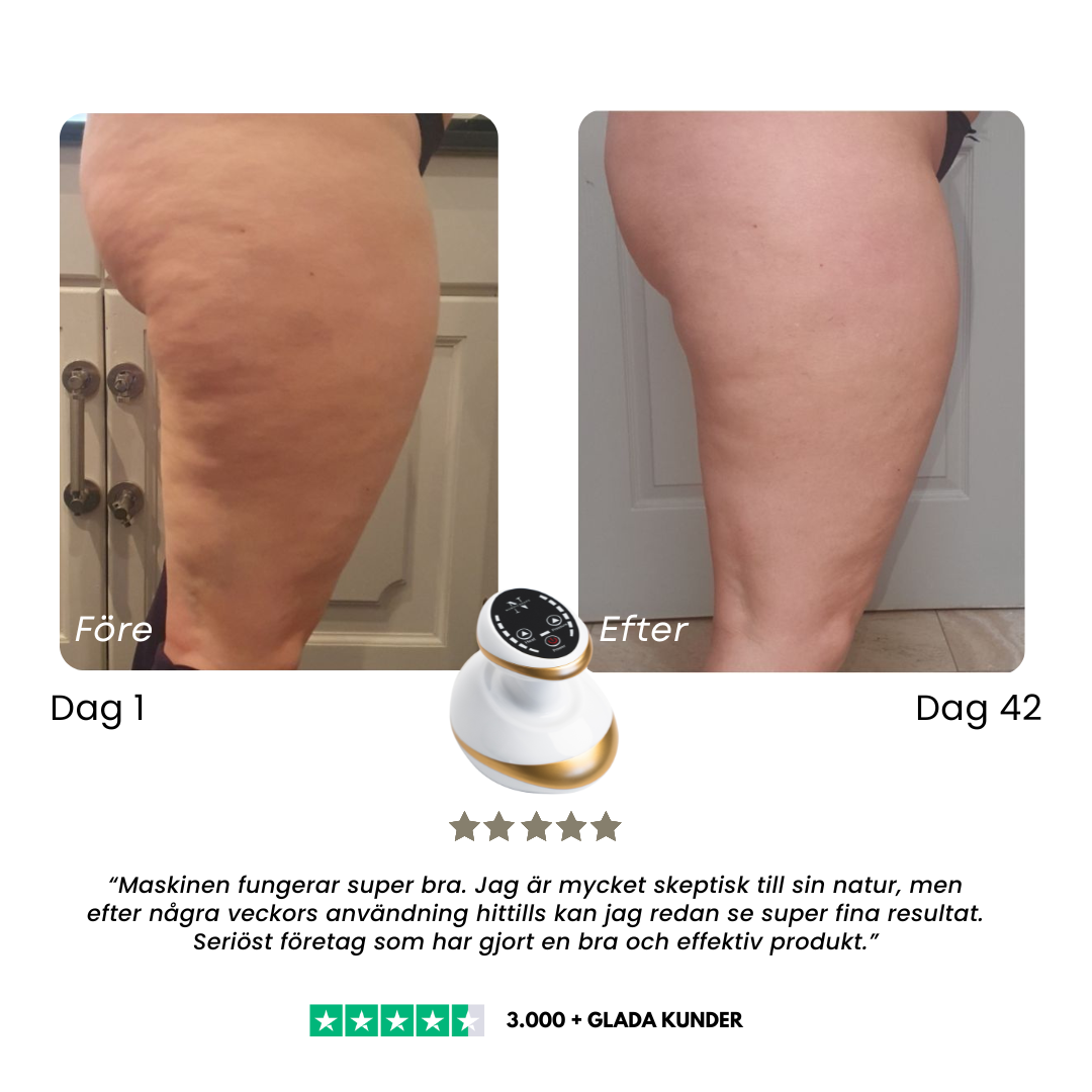 CelluSmooth™ – Cellulit massageapparat