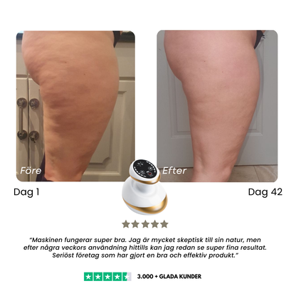 CelluSmooth™ – Cellulit massageapparat
