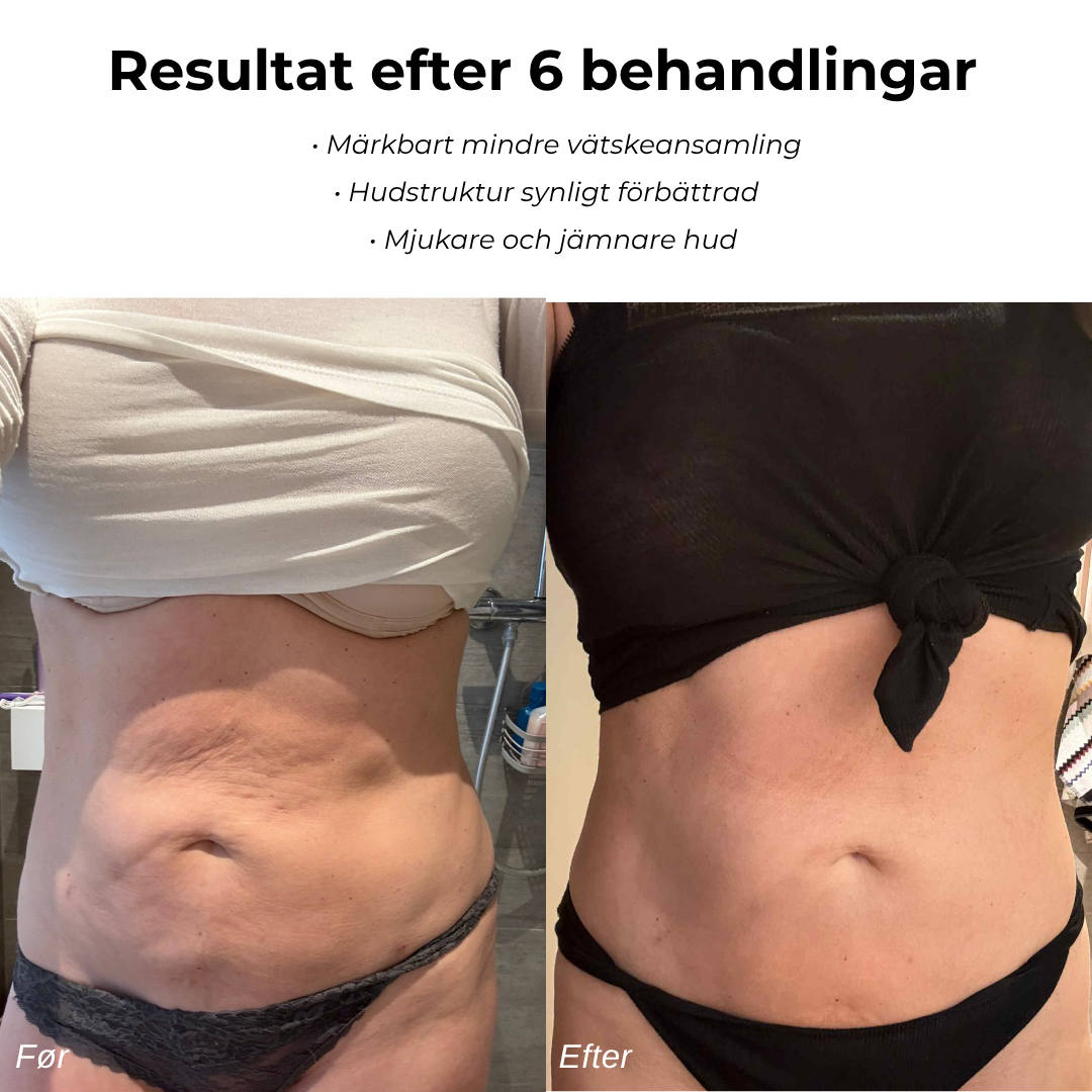 CelluSmooth™ – Cellulit massageapparat